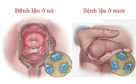 Điều trị viêm đường tiết niệu khi mang thai bằng đơn thuốc an toàn hiệu quả